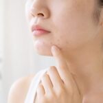 あごニキビを繰り返すのはなぜ? あごニキビ