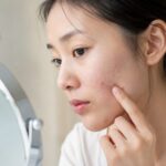 赤ニキビと白ニキビは、漢方ではどう違う? 白赤ニキビ